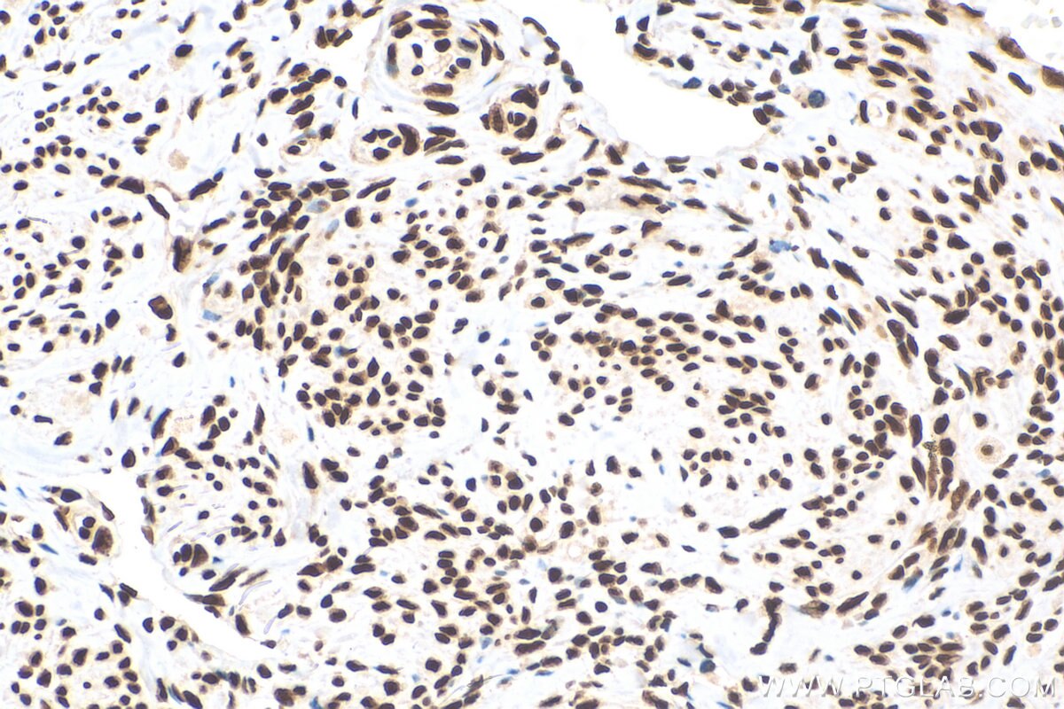 IHC staining of human cervical cancer using 68236-1-Ig