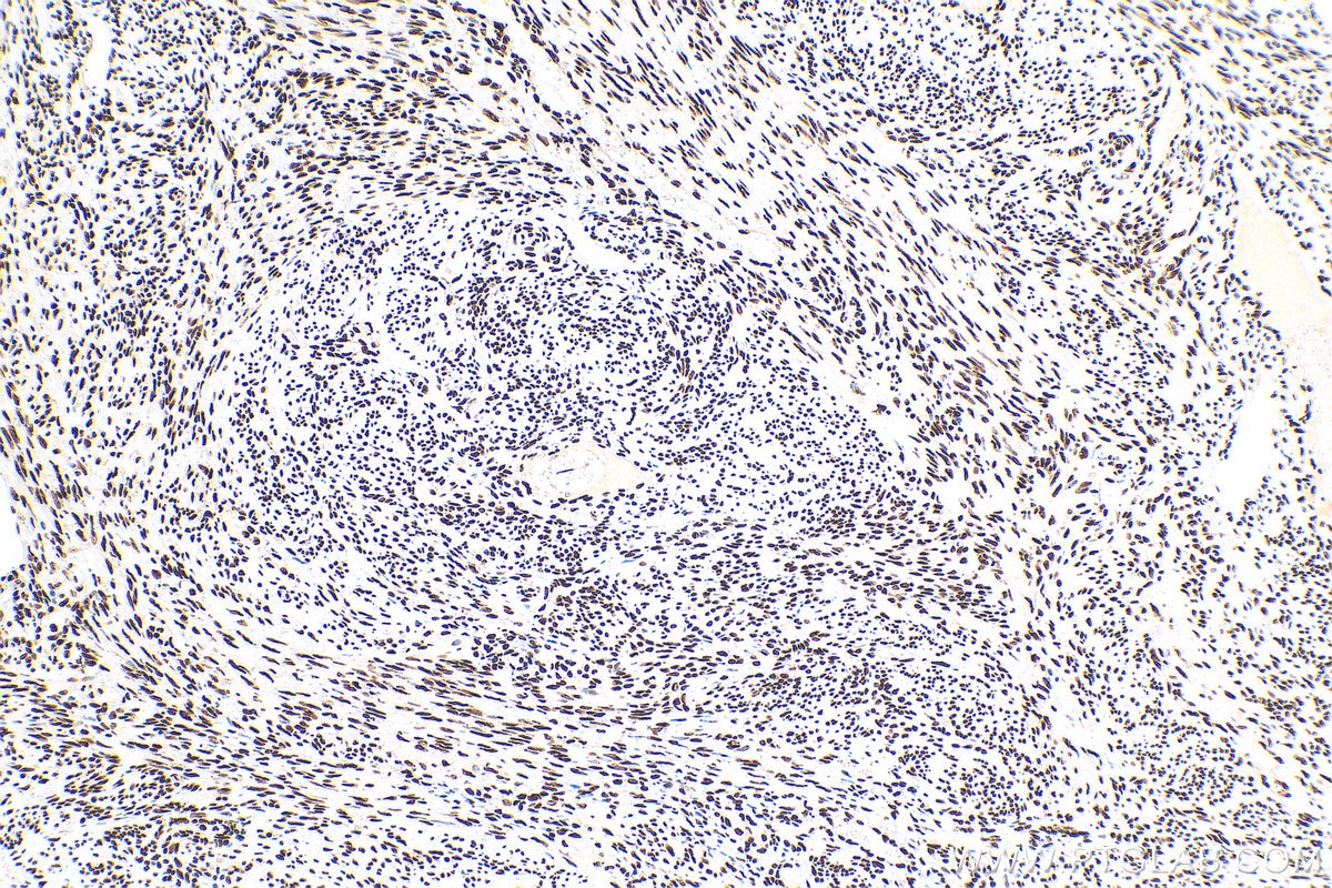 Immunohistochemistry (IHC) staining of human cervical cancer tissue using HNRNPD Monoclonal antibody (68236-1-Ig)