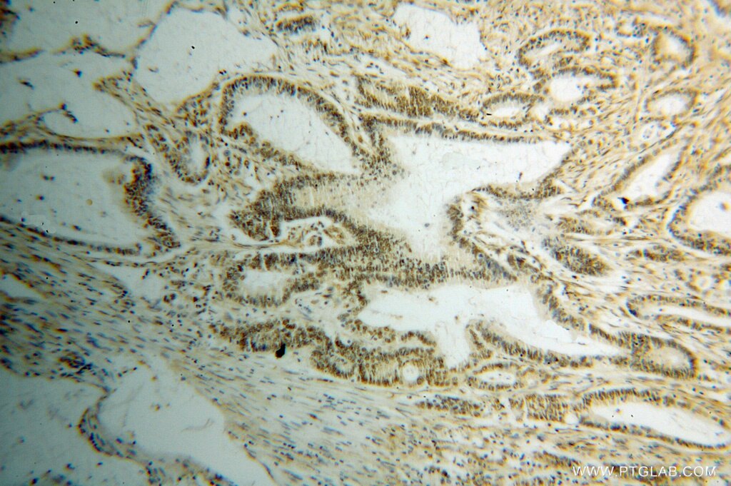 Immunohistochemistry (IHC) staining of human colon cancer tissue using HNRNPF Polyclonal antibody (14974-1-AP)