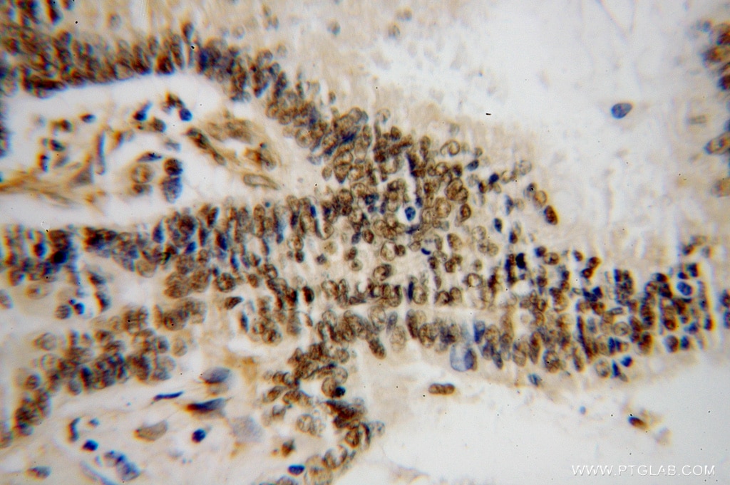 Immunohistochemistry (IHC) staining of human colon cancer tissue using HNRNPF Polyclonal antibody (14974-1-AP)