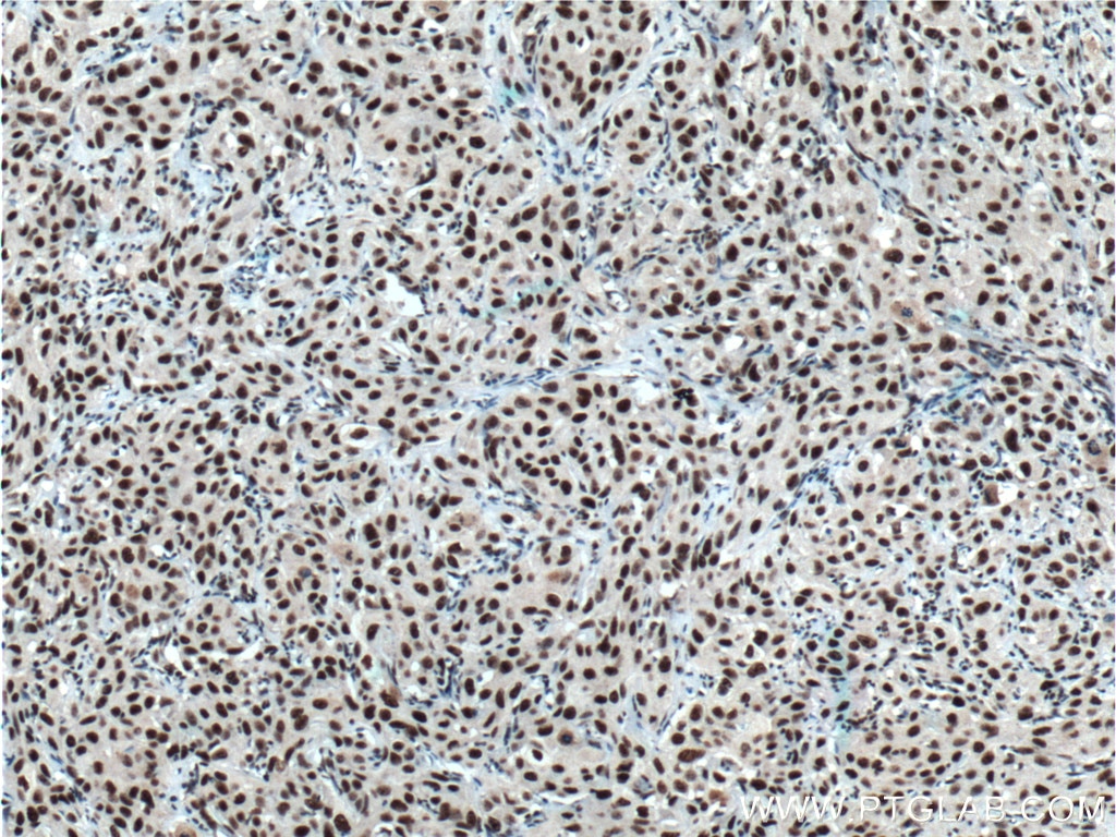 Immunohistochemistry (IHC) staining of human cervical cancer tissue using HNRNPH1 Polyclonal antibody (14774-1-AP)