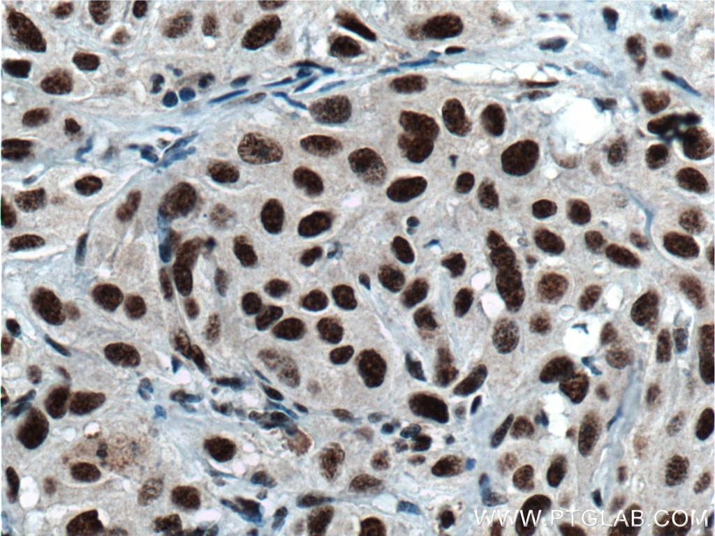 Immunohistochemistry (IHC) staining of human cervical cancer tissue using HNRNPH1 Polyclonal antibody (14774-1-AP)