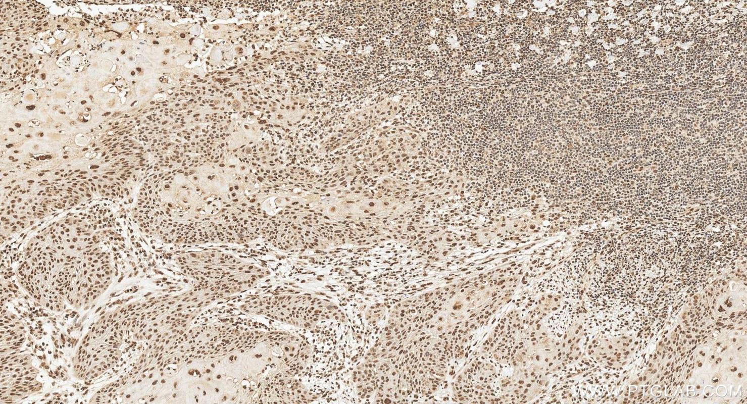 Immunohistochemistry (IHC) staining of human cervical cancer tissue using HNRNPH1 Polyclonal antibody (14774-1-AP)