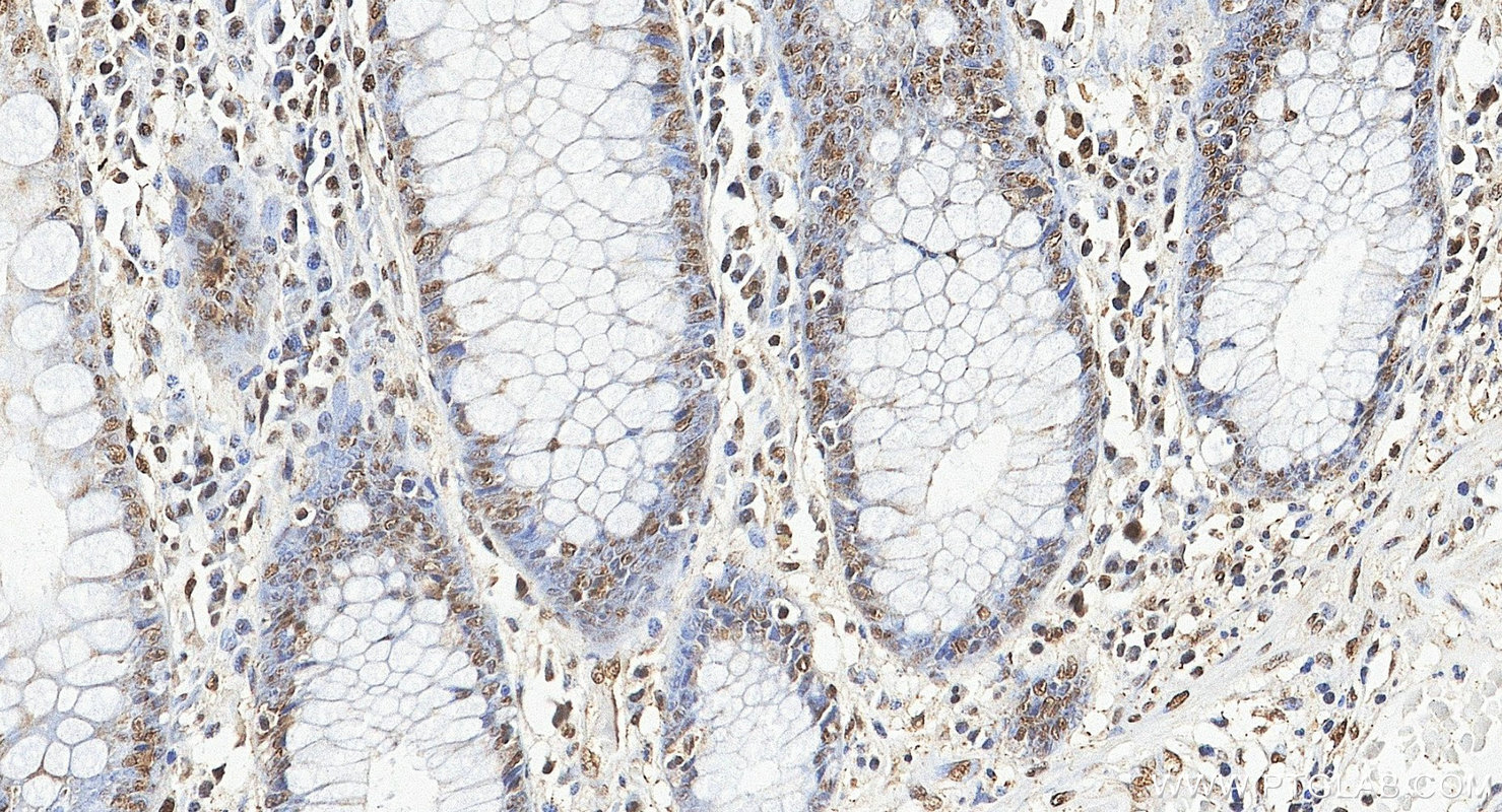 Immunohistochemistry (IHC) staining of human colon tissue using HNRNPH1 Polyclonal antibody (14774-1-AP)