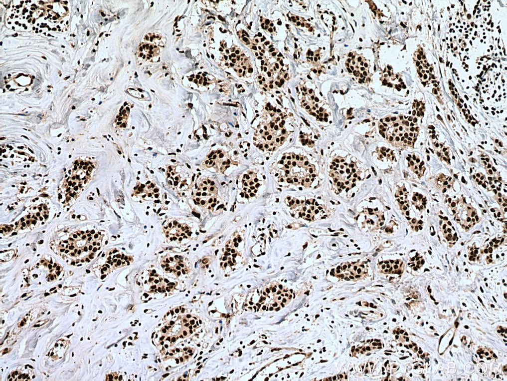 Immunohistochemistry (IHC) staining of human breast cancer tissue using HNRNPH1 Monoclonal antibody (67375-1-Ig)