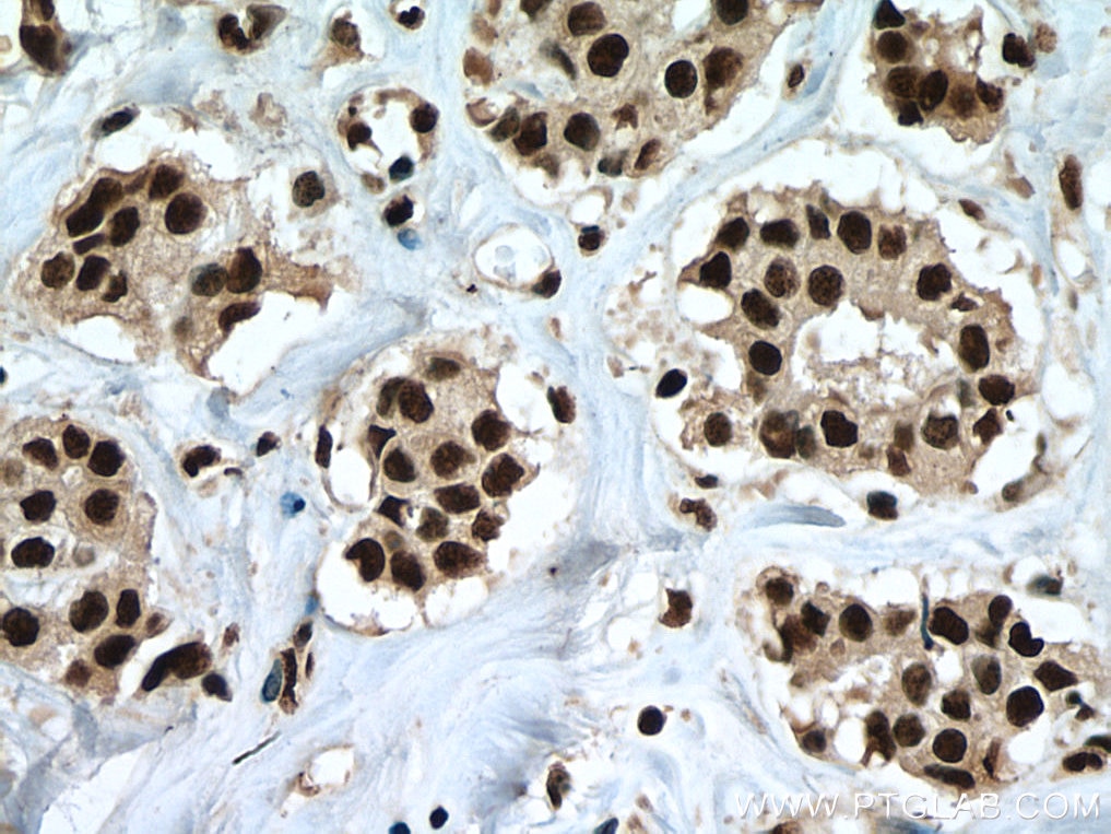 Immunohistochemistry (IHC) staining of human breast cancer tissue using HNRNPH1 Monoclonal antibody (67375-1-Ig)