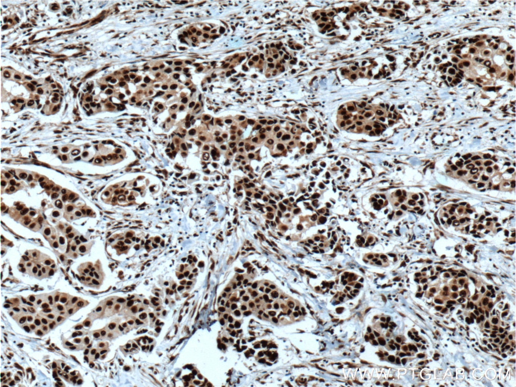 Immunohistochemistry (IHC) staining of human breast cancer tissue using HNRNPK Polyclonal antibody (11426-1-AP)