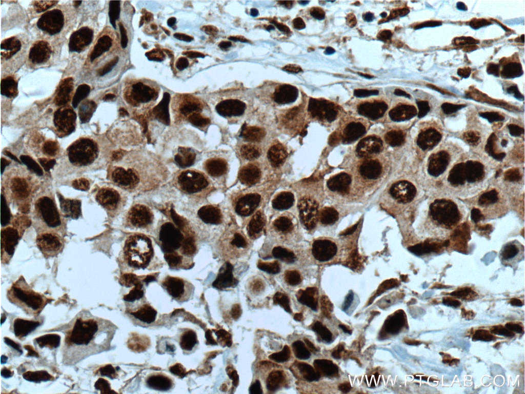 Immunohistochemistry (IHC) staining of human breast cancer tissue using HNRNPK Polyclonal antibody (11426-1-AP)