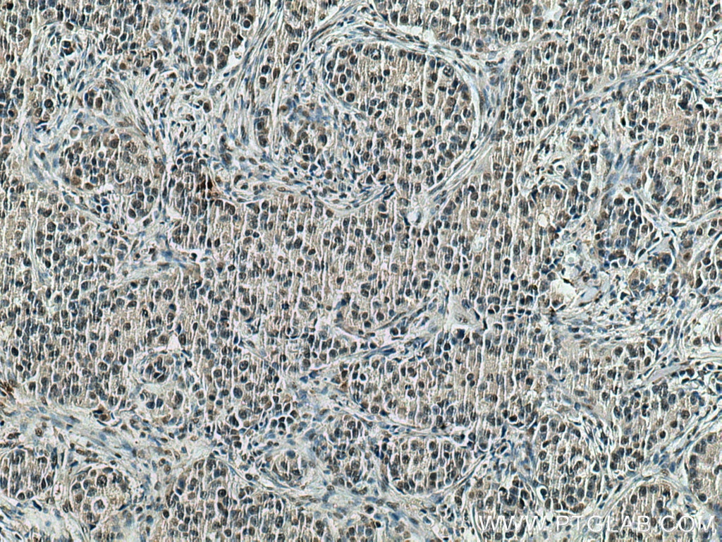 Immunohistochemistry (IHC) staining of human breast cancer tissue using HNRNPK Monoclonal antibody (67708-1-Ig)