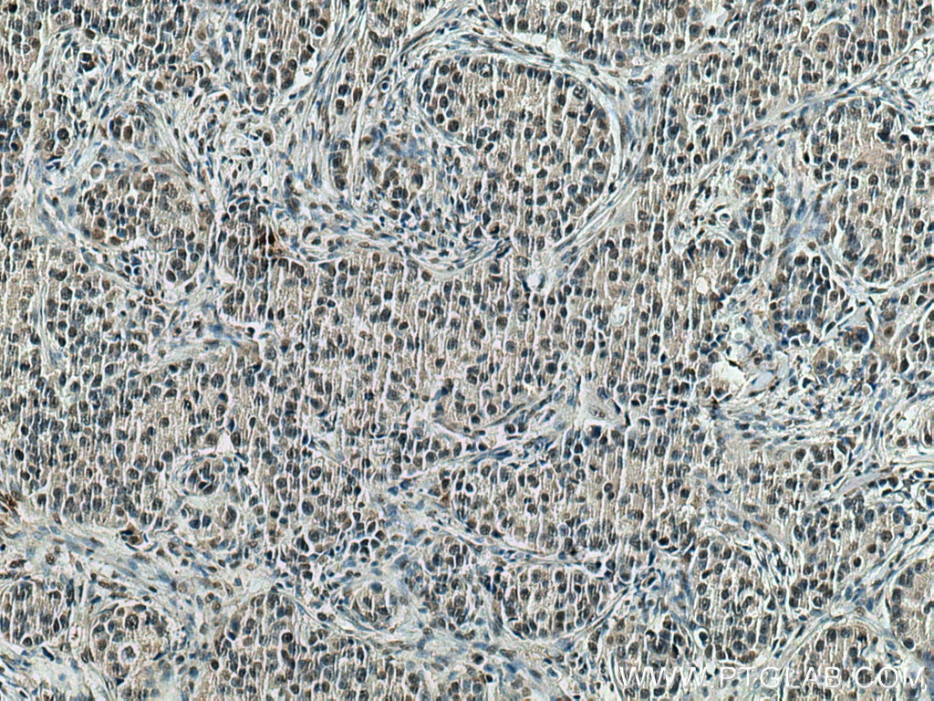 IHC staining of human breast cancer using 67708-1-Ig