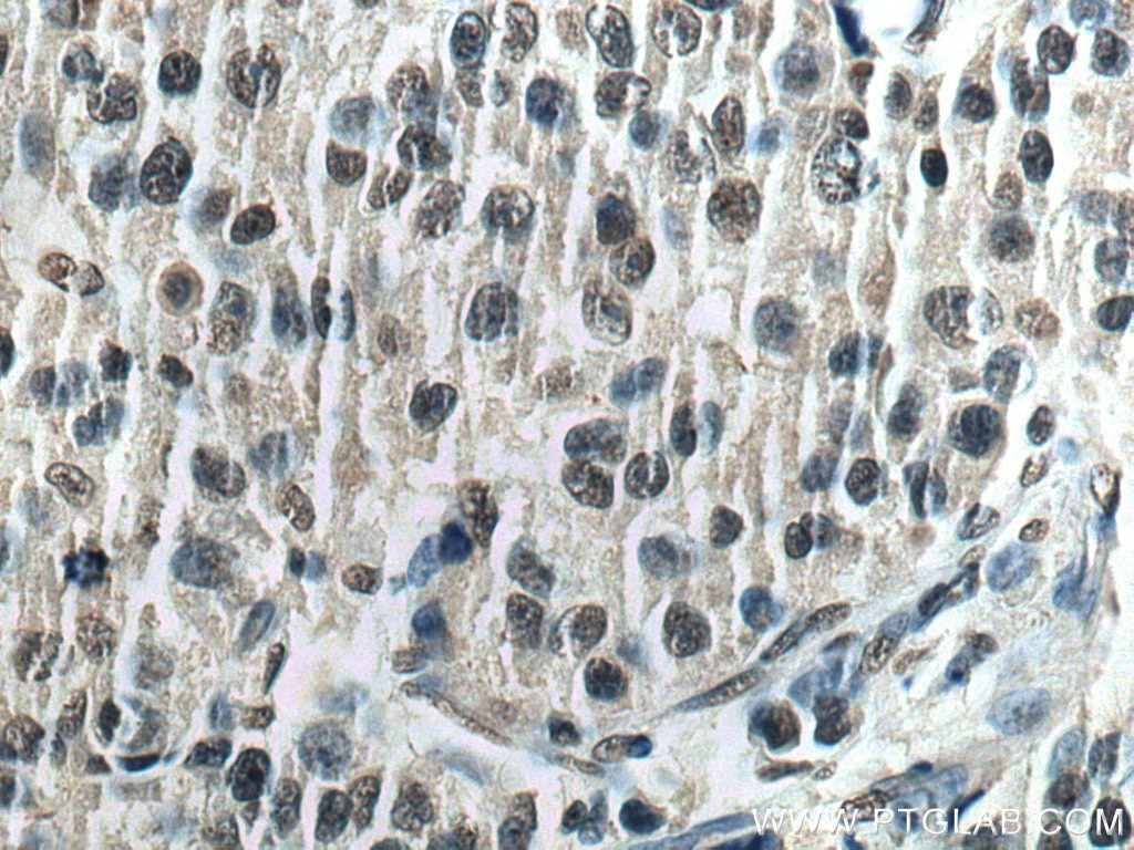 Immunohistochemistry (IHC) staining of human breast cancer tissue using HNRNPK Monoclonal antibody (67708-1-Ig)