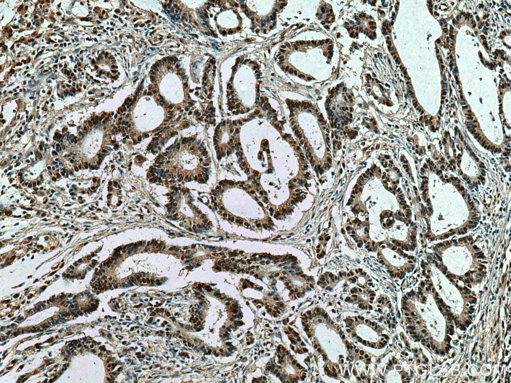 Immunohistochemistry (IHC) staining of human colon cancer tissue using HNRNPK Monoclonal antibody (67708-1-Ig)