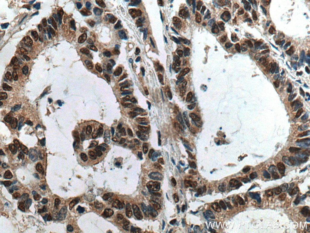 Immunohistochemistry (IHC) staining of human colon cancer tissue using HNRNPK Monoclonal antibody (67708-1-Ig)