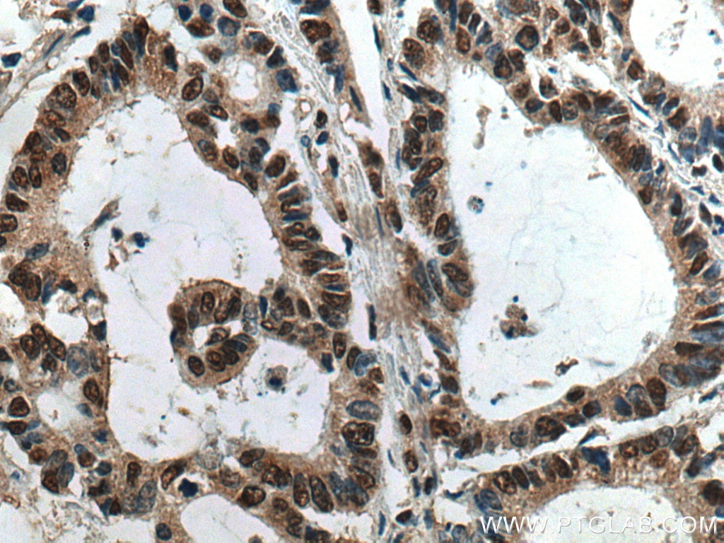 IHC staining of human colon cancer using 67708-1-Ig