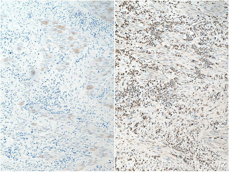 IHC staining of human stomach cancer using 18354-1-AP