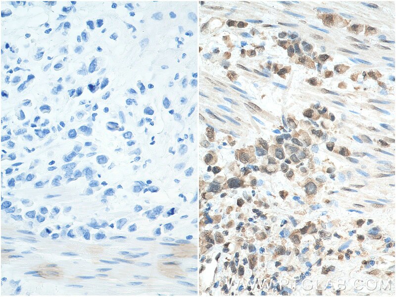 IHC staining of human stomach cancer using 18354-1-AP