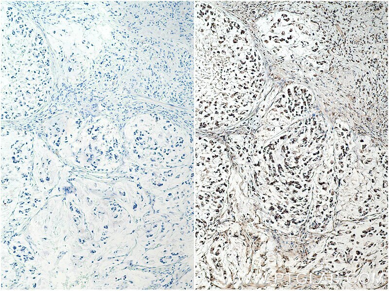 IHC staining of human stomach cancer using 18354-1-AP