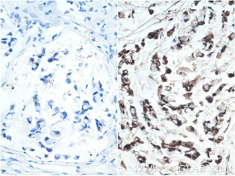 Immunohistochemistry (IHC) staining of human stomach cancer tissue using HNRNPL Polyclonal antibody (18354-1-AP)