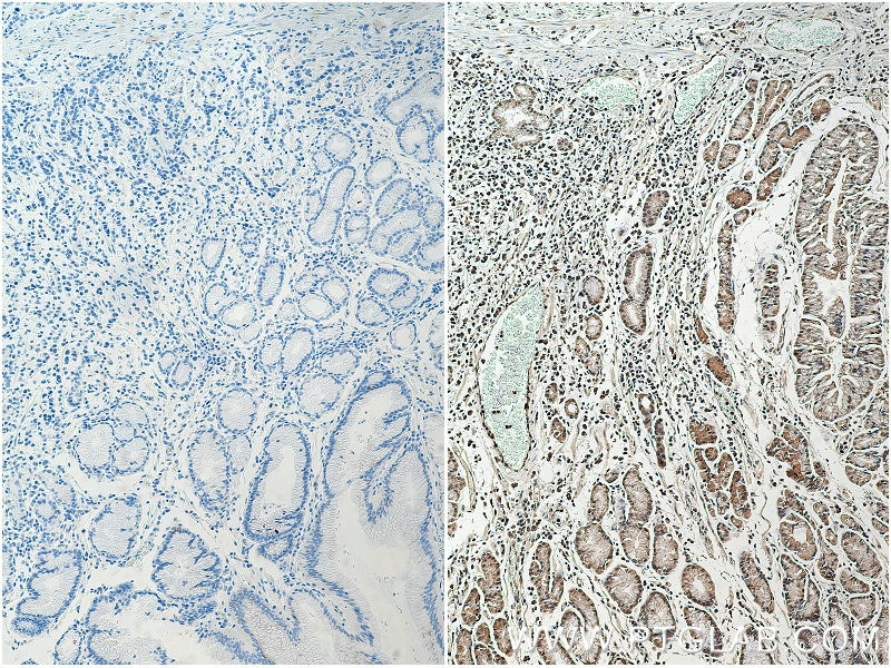 Immunohistochemistry (IHC) staining of human stomach cancer tissue using HNRNPL Polyclonal antibody (18354-1-AP)