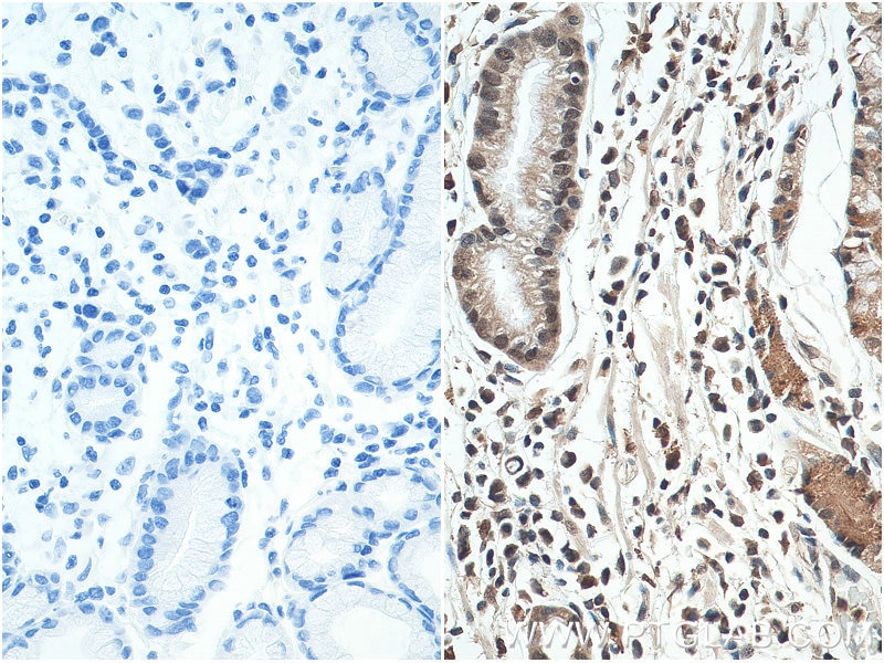 IHC staining of human stomach cancer using 18354-1-AP