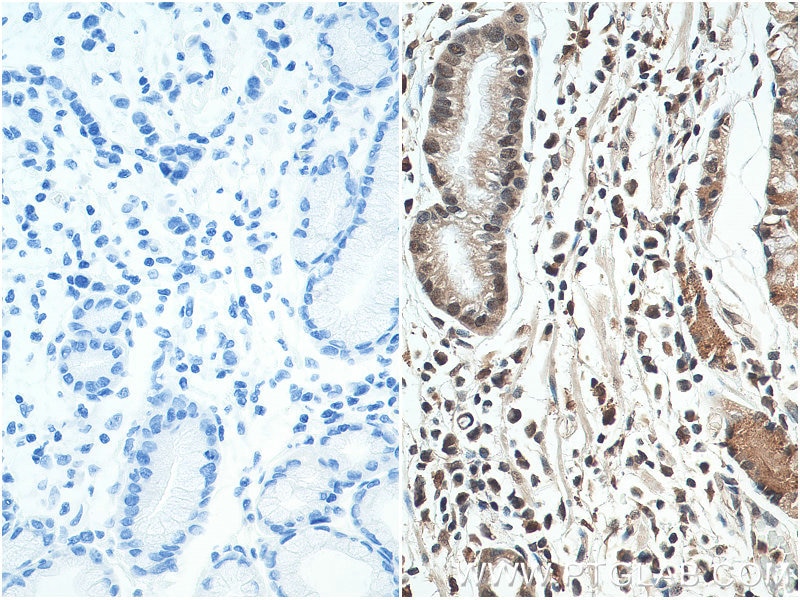 Immunohistochemistry (IHC) staining of human stomach cancer tissue using HNRNPL Polyclonal antibody (18354-1-AP)