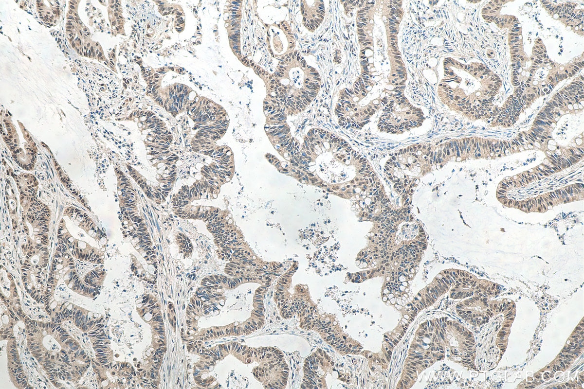 Immunohistochemistry (IHC) staining of human colon cancer tissue using HNRNPL Polyclonal antibody (18354-1-AP)