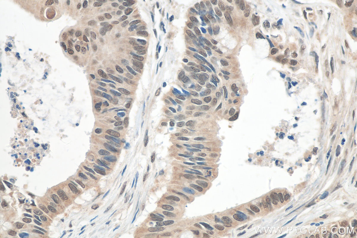 IHC staining of human colon cancer using 18354-1-AP