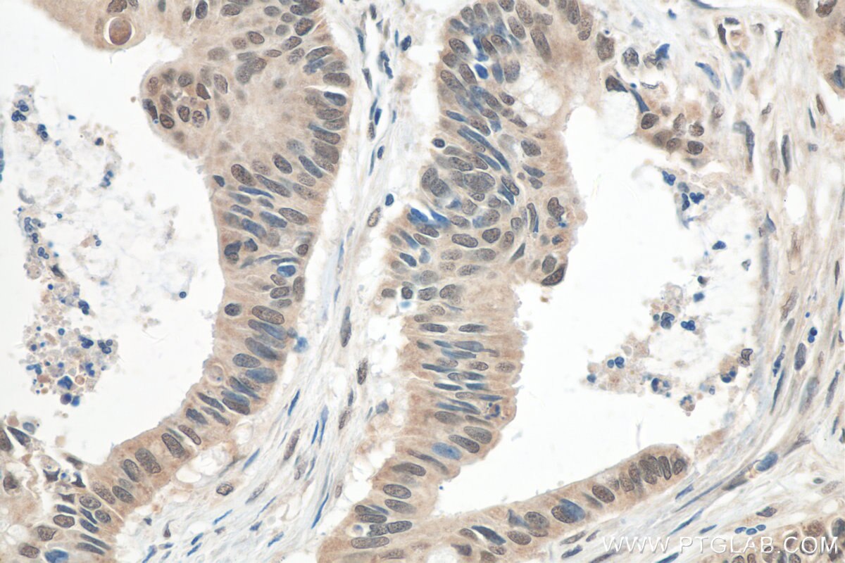 Immunohistochemistry (IHC) staining of human colon cancer tissue using HNRNPL Polyclonal antibody (18354-1-AP)