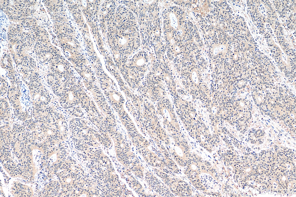 Immunohistochemistry (IHC) staining of human colon cancer tissue using HNRNPL Recombinant antibody (82259-1-RR)