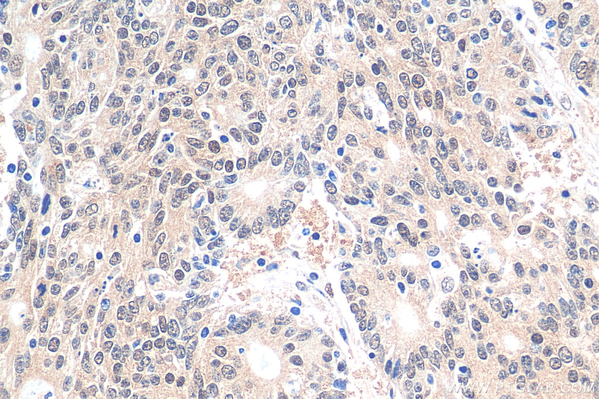 Immunohistochemistry (IHC) staining of human colon cancer tissue using HNRNPL Recombinant antibody (82259-1-RR)