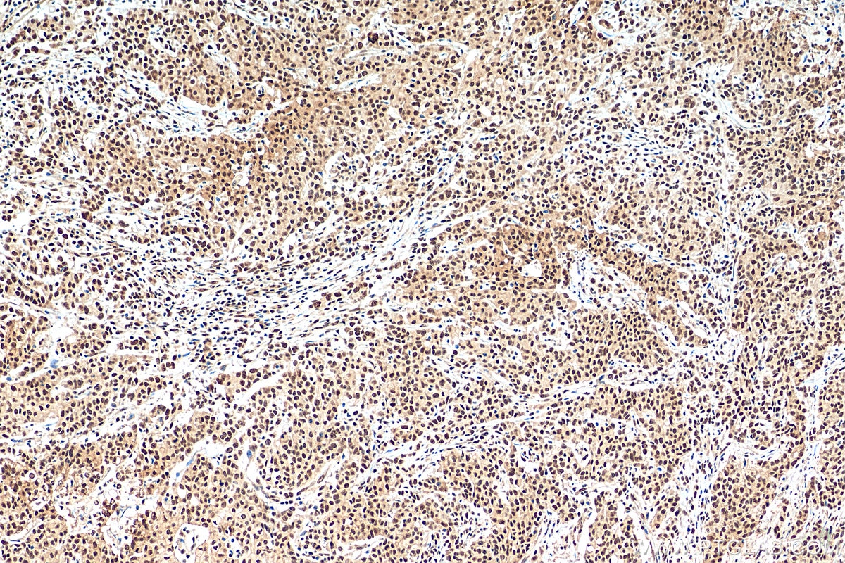 Immunohistochemistry (IHC) staining of human stomach cancer tissue using HNRNPL Recombinant antibody (82259-1-RR)