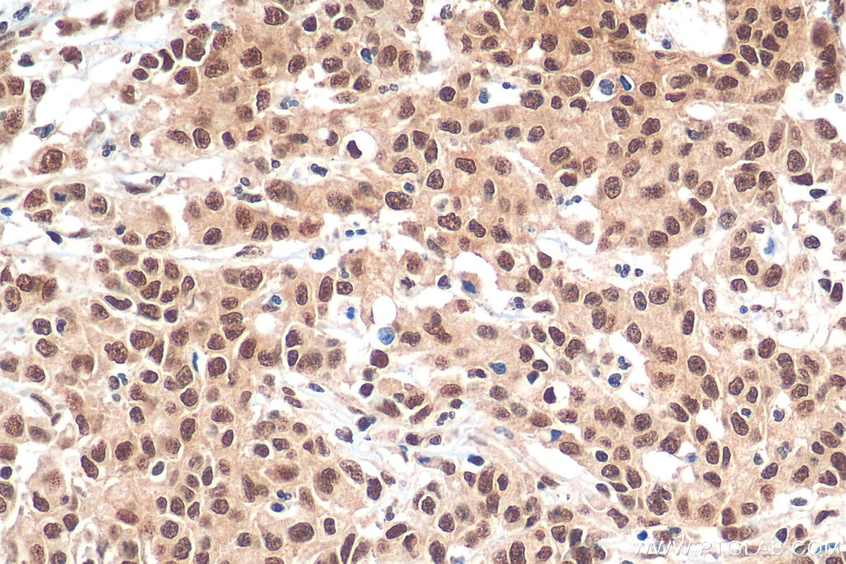 Immunohistochemistry (IHC) staining of human stomach cancer tissue using HNRNPL Recombinant antibody (82259-1-RR)
