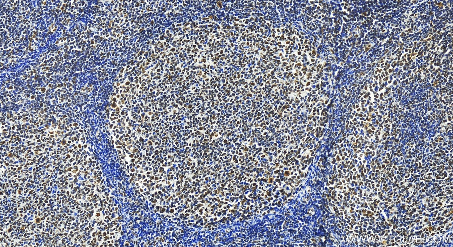 Immunohistochemistry (IHC) staining of human tonsillitis tissue using HNRNPM Polyclonal antibody (26897-1-AP)