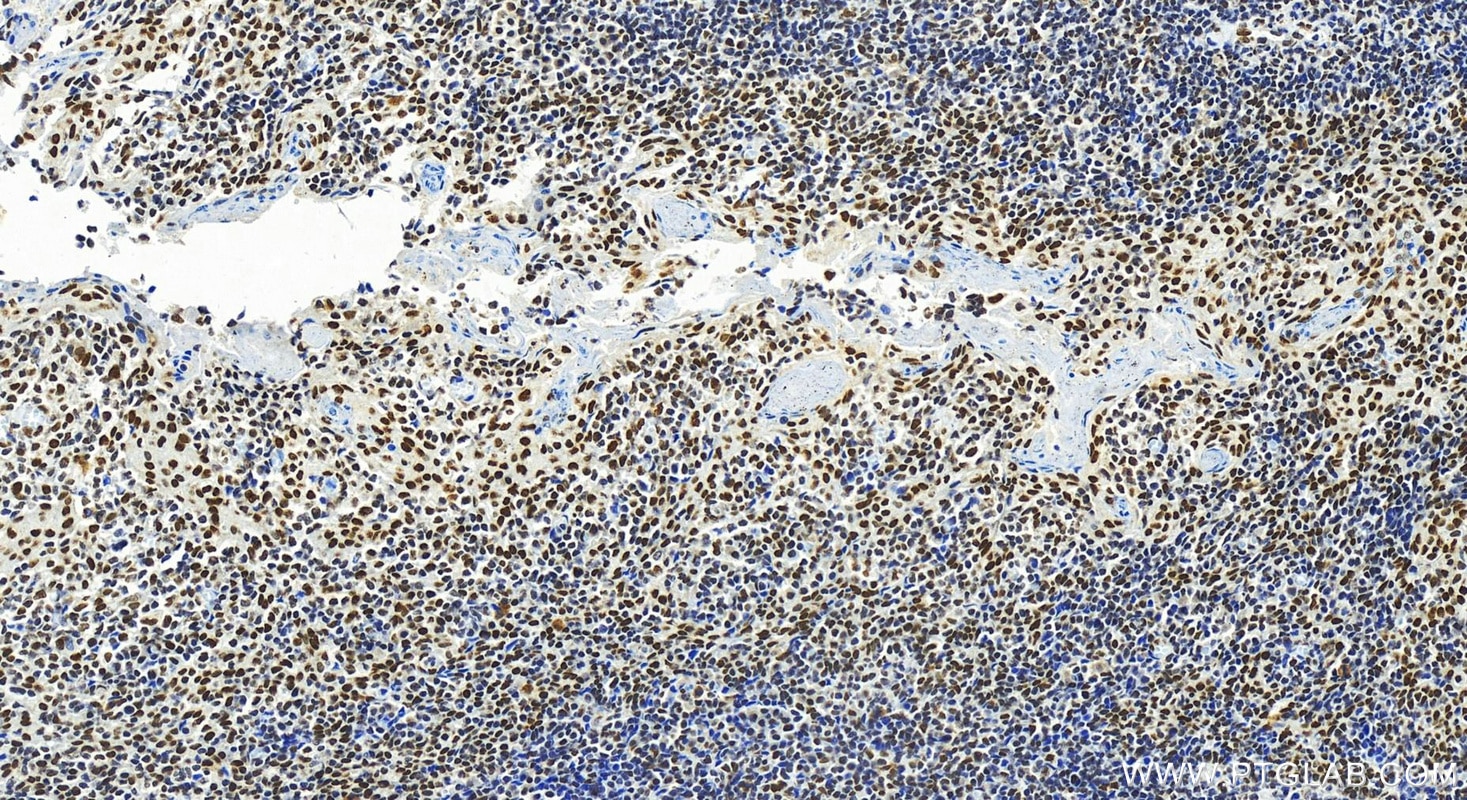 Immunohistochemistry (IHC) staining of human tonsillitis tissue using HNRNPM Polyclonal antibody (26897-1-AP)