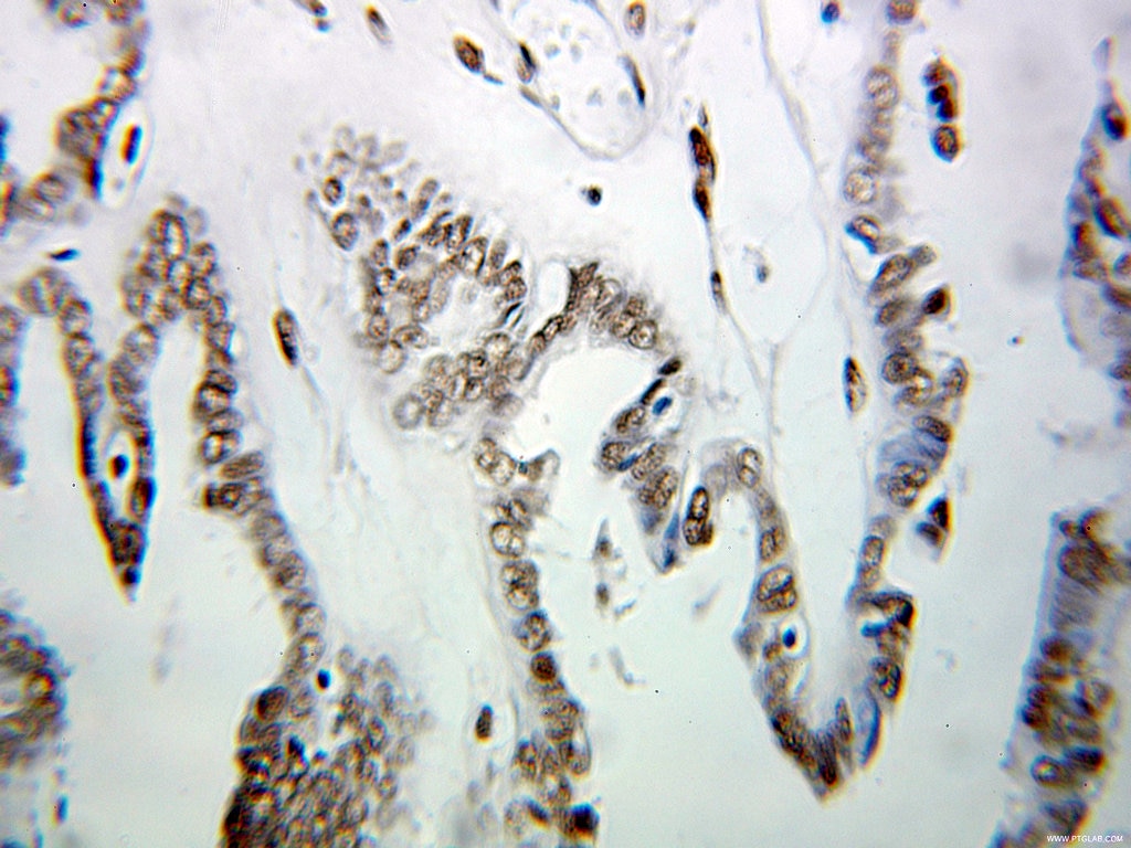 Immunohistochemistry (IHC) staining of human ovary tumor tissue using HNRNPUL1 Polyclonal antibody (10578-1-AP)