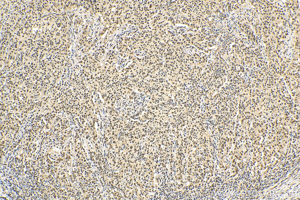 Immunohistochemistry (IHC) staining of human stomach cancer tissue using HNRPLL Polyclonal antibody (26769-1-AP)