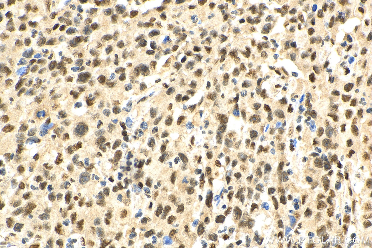 Immunohistochemistry (IHC) staining of human stomach cancer tissue using HNRPLL Polyclonal antibody (26769-1-AP)