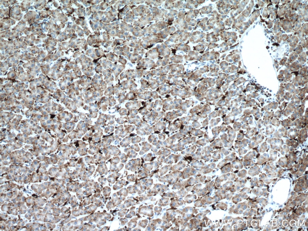 Immunohistochemistry (IHC) staining of human liver cancer tissue using HO-1/HMOX1 Monoclonal antibody (66743-1-Ig)