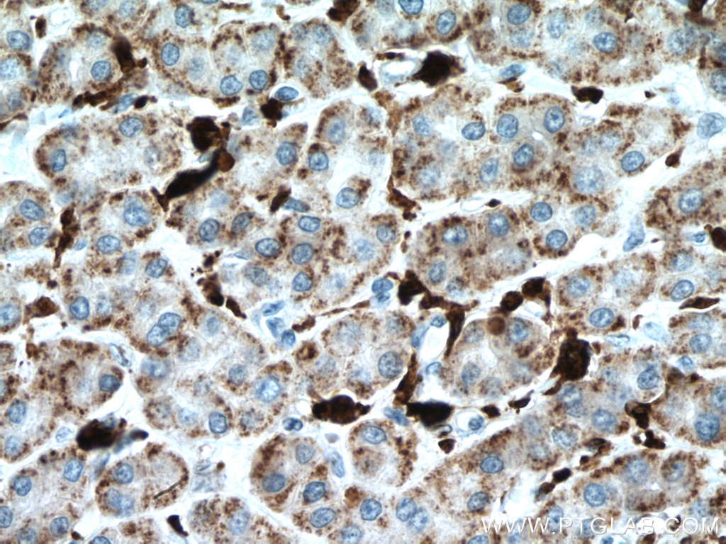 Immunohistochemistry (IHC) staining of human liver cancer tissue using HO-1/HMOX1 Monoclonal antibody (66743-1-Ig)