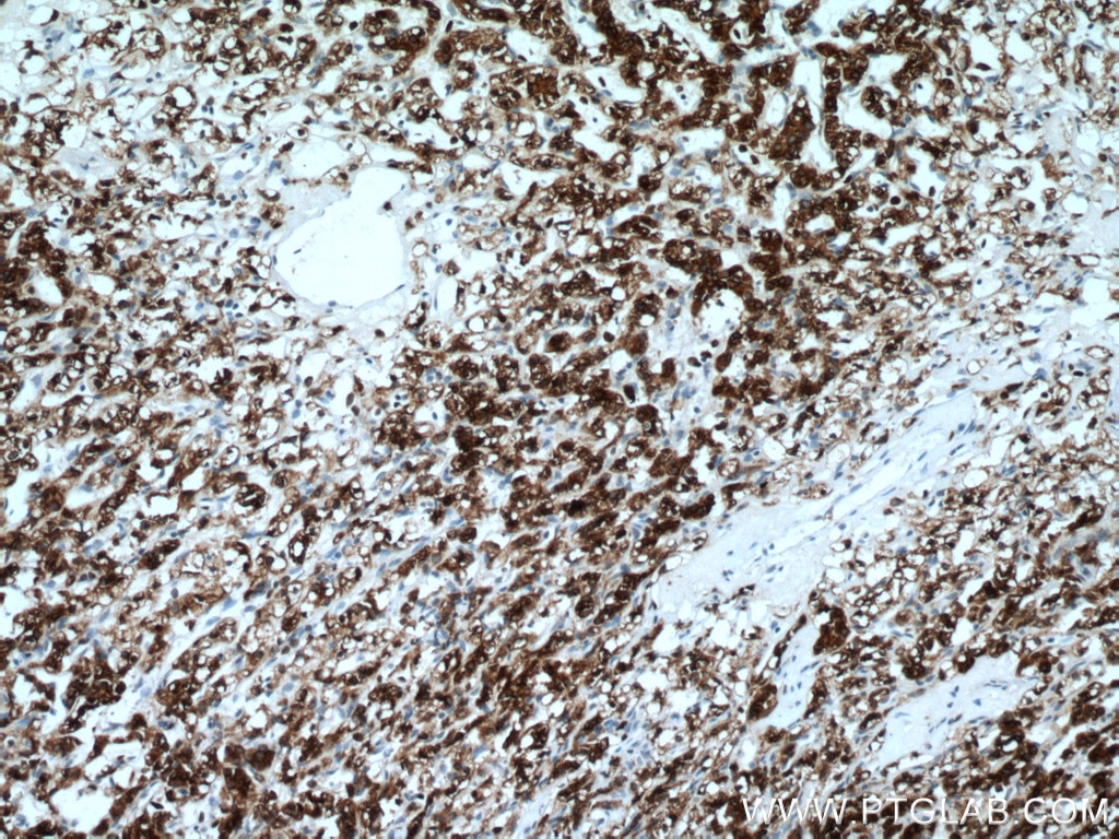 Immunohistochemistry (IHC) staining of human renal cell carcinoma tissue using HO-1/HMOX1 Monoclonal antibody (66743-1-Ig)