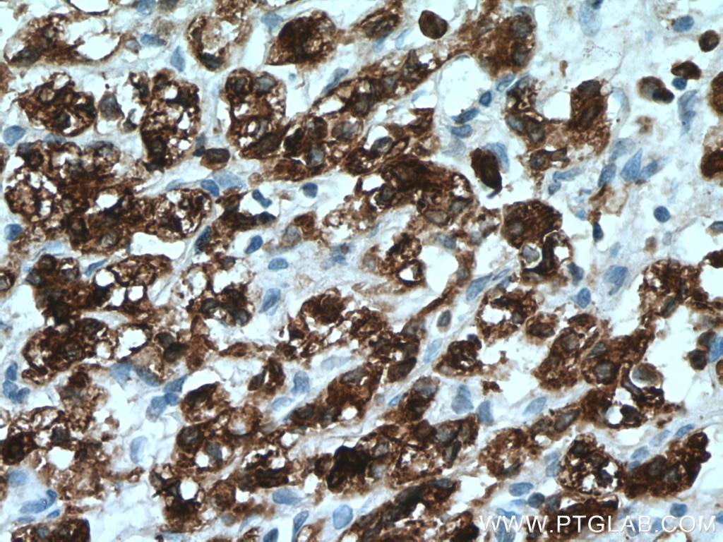 Immunohistochemistry (IHC) staining of human renal cell carcinoma tissue using HO-1/HMOX1 Monoclonal antibody (66743-1-Ig)