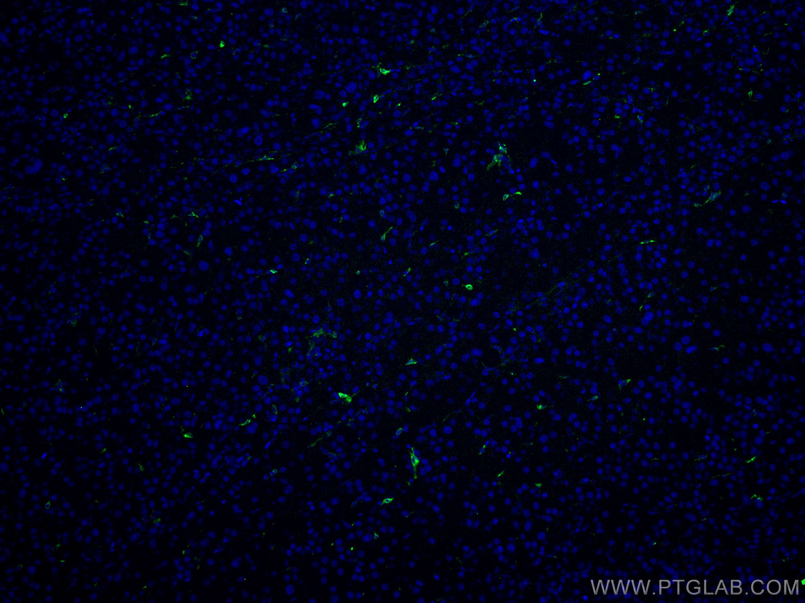 Immunofluorescence (IF) / fluorescent staining of human liver cancer tissue using CoraLite® Plus 488-conjugated HO-1/HMOX1 Polyclona (CL488-10701)