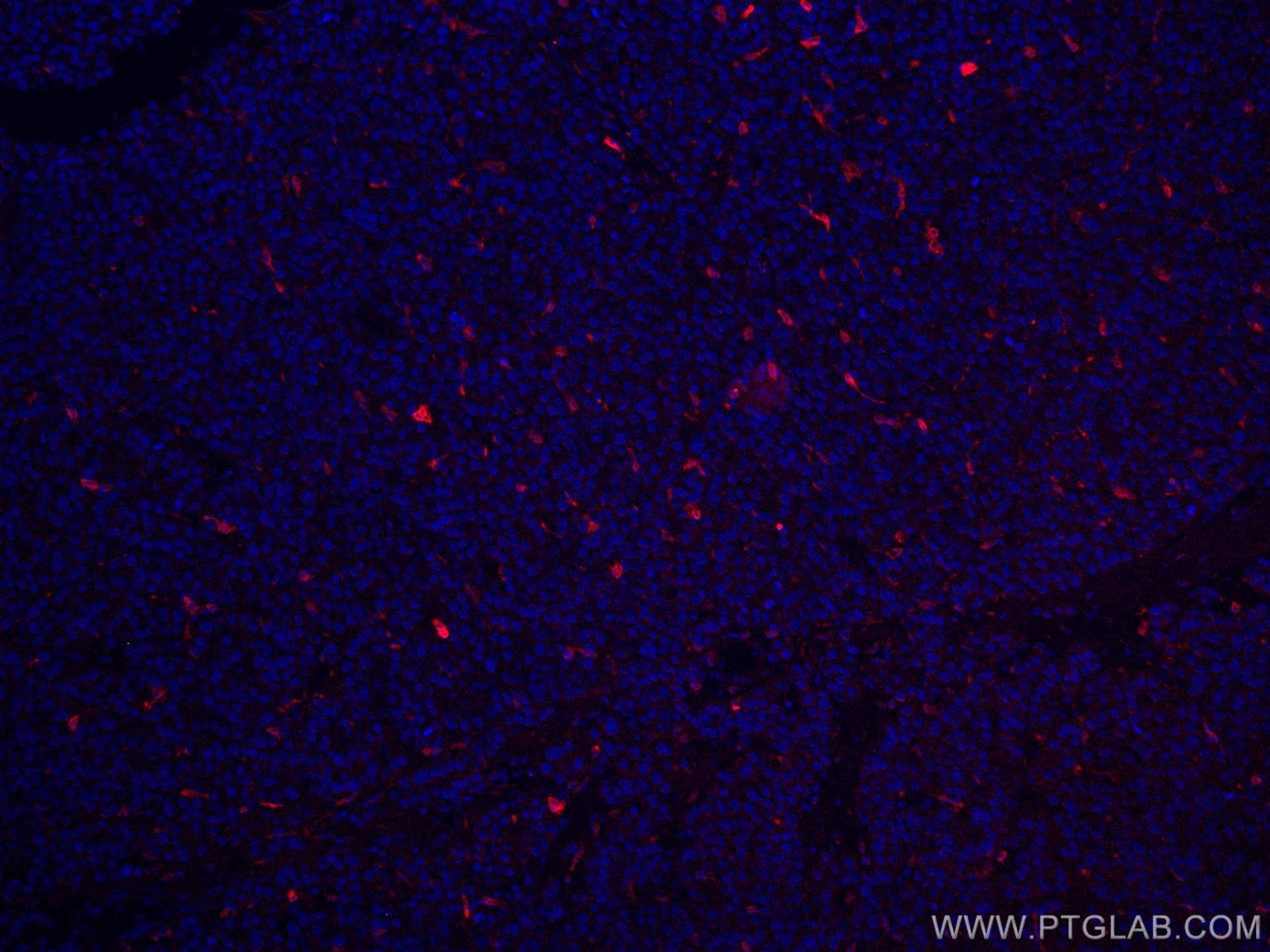 Immunofluorescence (IF) / fluorescent staining of human liver cancer tissue using CoraLite®594-conjugated HO-1/HMOX1 Polyclonal anti (CL594-10701)