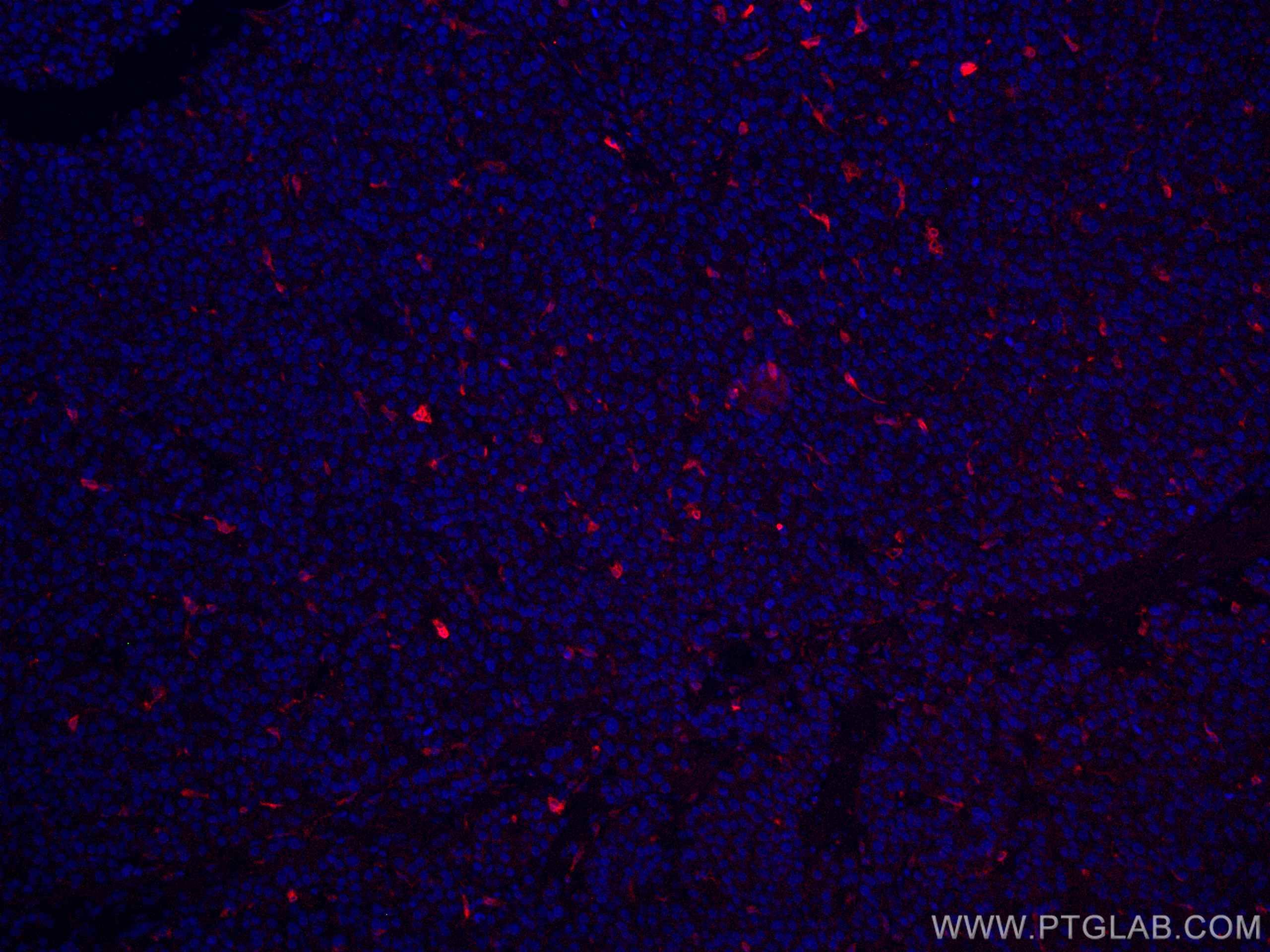 IF Staining of human liver cancer using CL594-10701