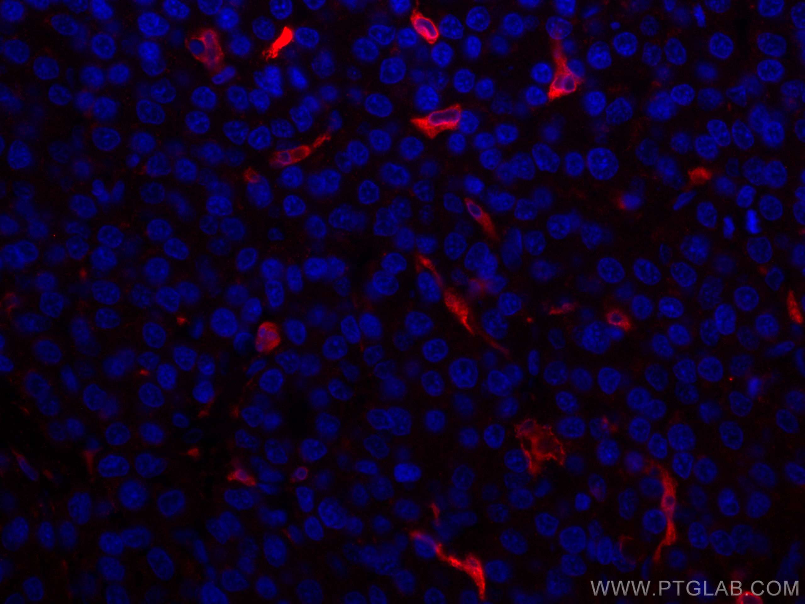 Immunofluorescence (IF) / fluorescent staining of human liver cancer tissue using CoraLite®594-conjugated HO-1/HMOX1 Polyclonal anti (CL594-10701)