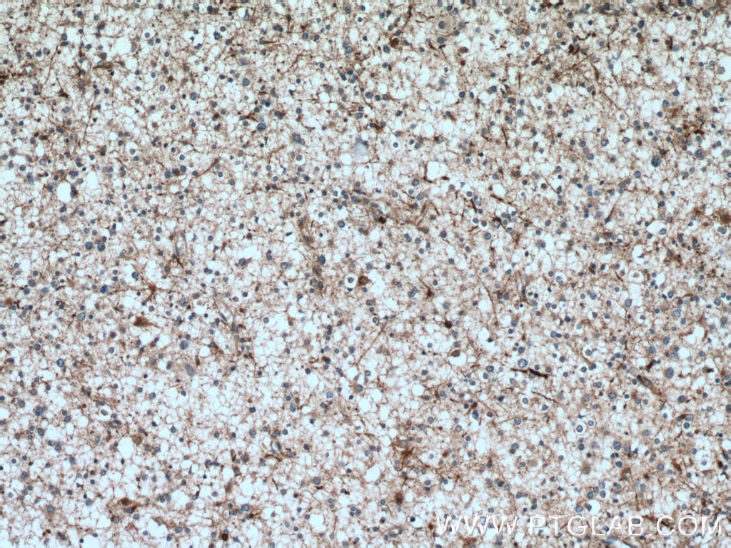 Immunohistochemistry (IHC) staining of human gliomas tissue using HOMER1 Polyclonal antibody (12433-1-AP)
