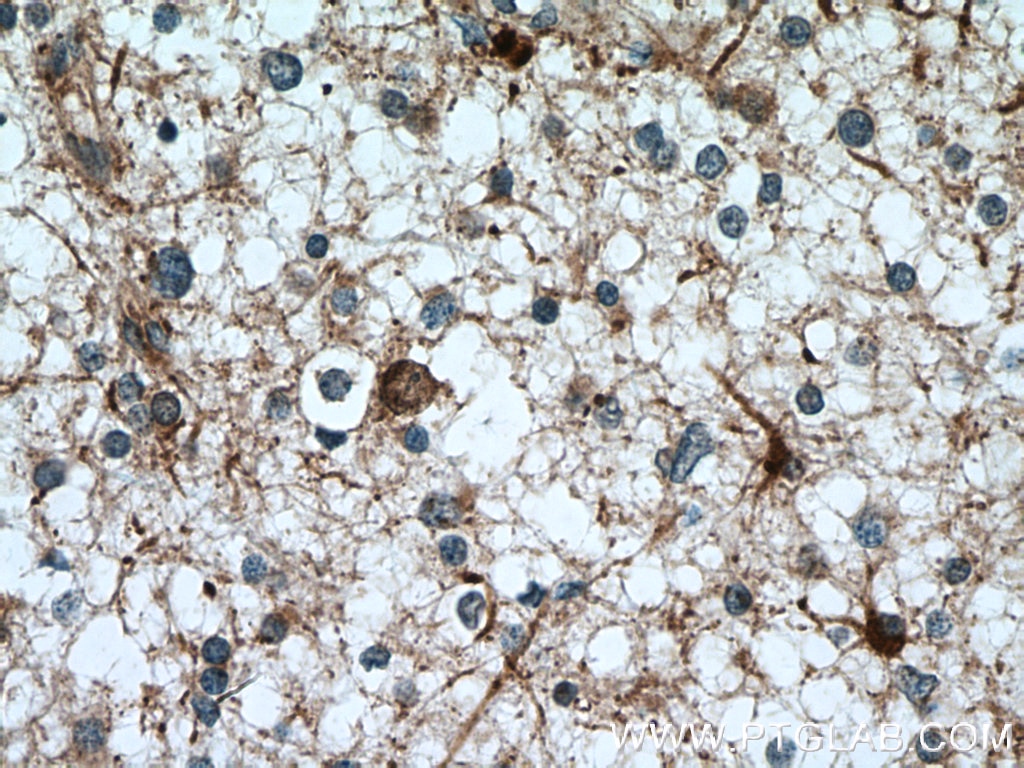 Immunohistochemistry (IHC) staining of human gliomas tissue using HOMER1 Polyclonal antibody (12433-1-AP)