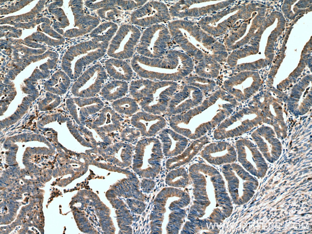 Immunohistochemistry (IHC) staining of human endometrial cancer tissue using HOMER2 Monoclonal antibody (67377-1-Ig)