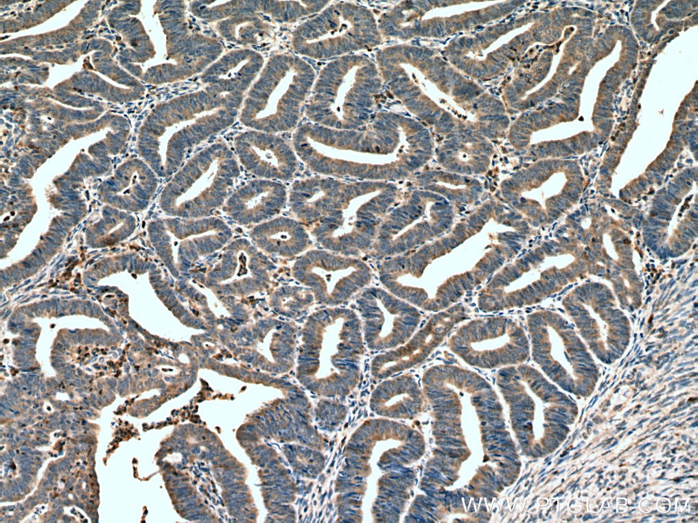 Immunohistochemistry (IHC) staining of human endometrial cancer tissue using HOMER2 Monoclonal antibody (67377-1-Ig)