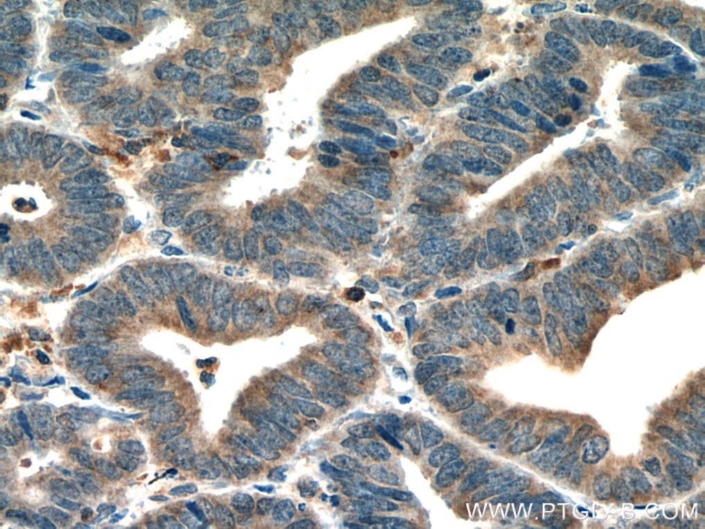 Immunohistochemistry (IHC) staining of human endometrial cancer tissue using HOMER2 Monoclonal antibody (67377-1-Ig)